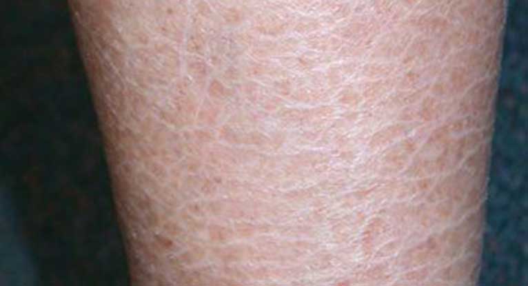 Rising Demand for Fish Skin Disease Treatment to Drive Growth of the Fish Skin Disease Market