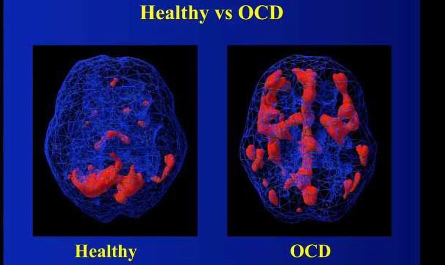 MRI Scans Reveal How Obsessive-Compulsive Disorder (OCD) Impacts the Brain’s Decision-Making Mechanisms