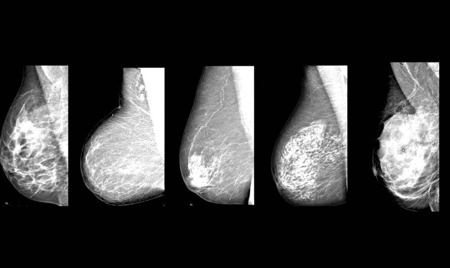 Breast Density Discussions Vary Based on Race, Ethnicity, and Literacy Level, Finds Study