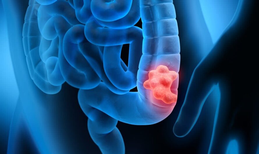Colorectal Cancer Screening Is Driven By Rising Prevalence Of Colorectal Cancer Risk Factors