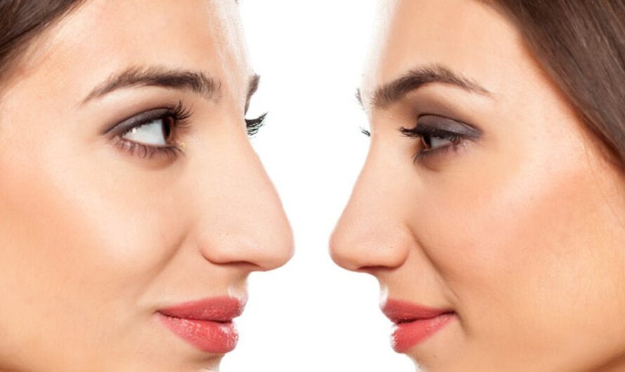 The Global Rhinoplasty Market Is Estimated To Propelled By Increasing Demand For Nose Reshaping Procedures