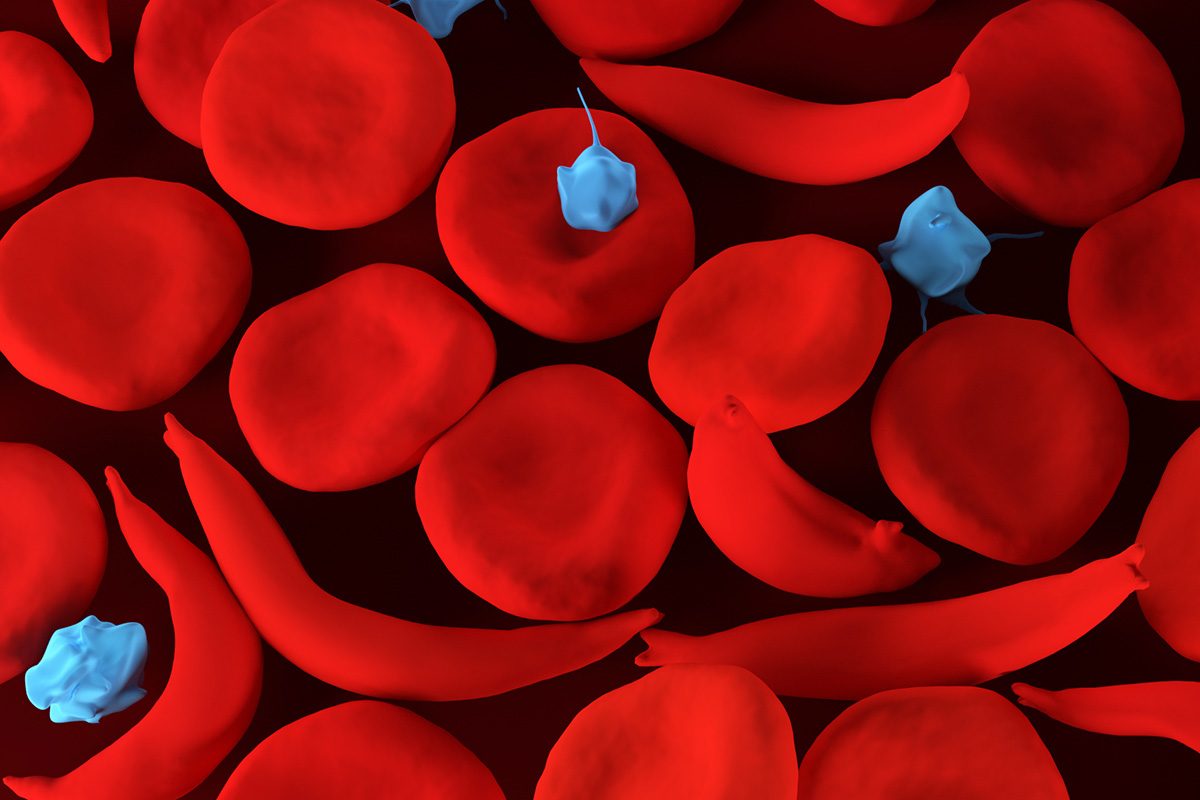 Hydroxyurea Demonstrates Significant Reduction in Infections in Children with Sickle Cell Anemia