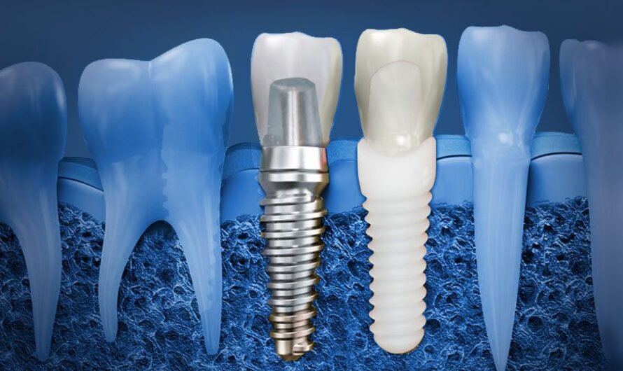 The global Dental Implants Market Demand is Boosted by Facial Appearance Growth