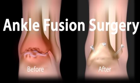 Global Ankle Fusion Nail