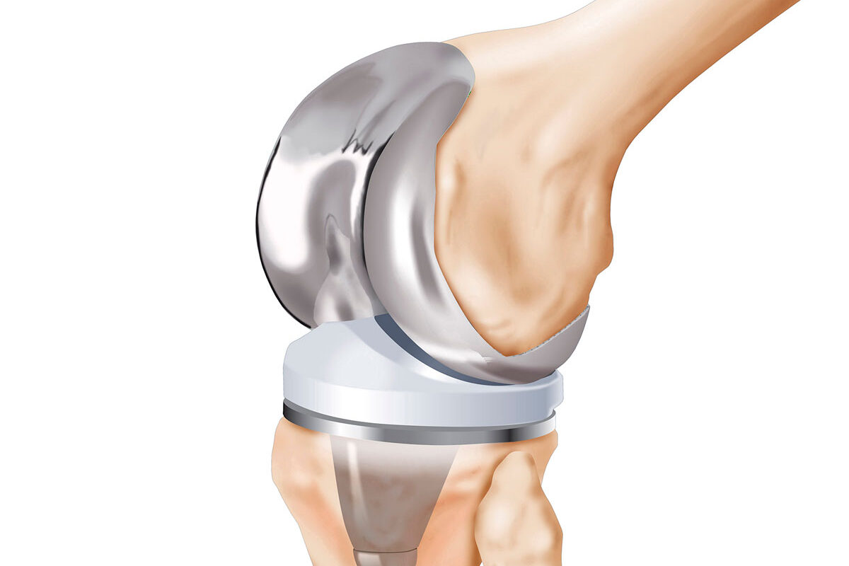 Total Knee Arthroplasty Market