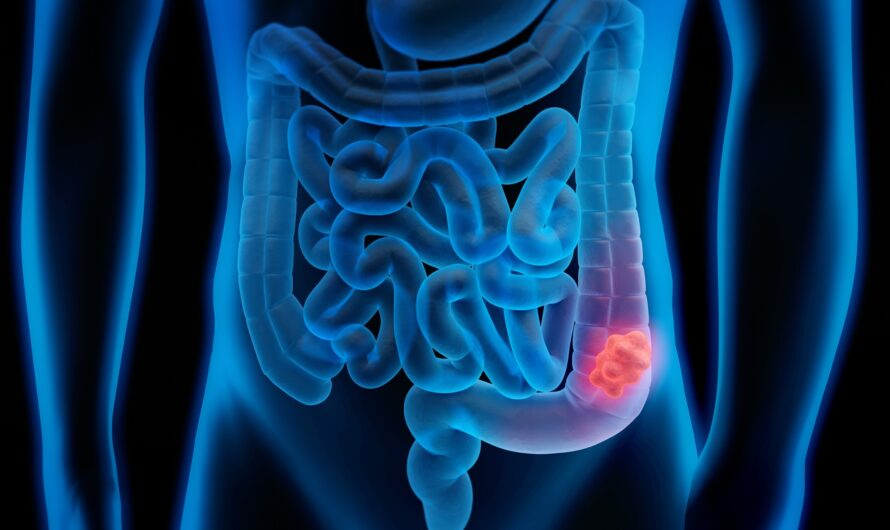 Colorectal Cancer Screening Market in U.S. Primed for Growth by Rising Disease Incidence